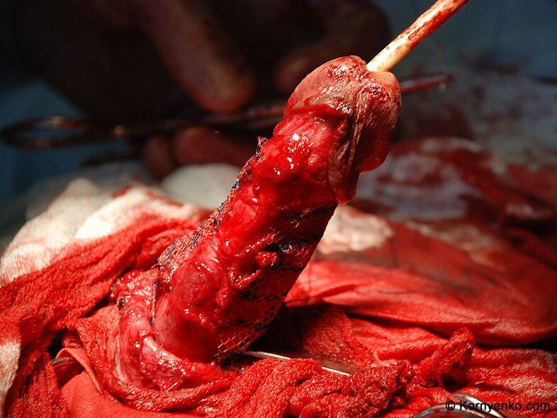 ugradnja kolagenske matrice za povećanje penisa