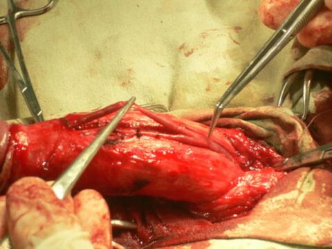 izvođenje operacije povećanja penisa