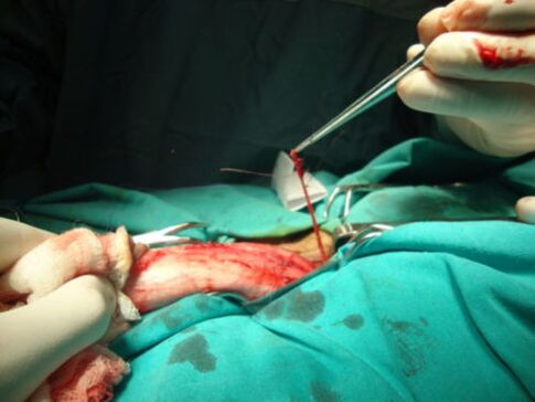 operacija povećanja penisa